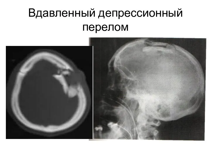 Вдавленный депрессионный перелом