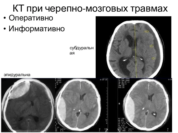 КТ при черепно-мозговых травмах Оперативно Информативно эпидуральная субдуральная