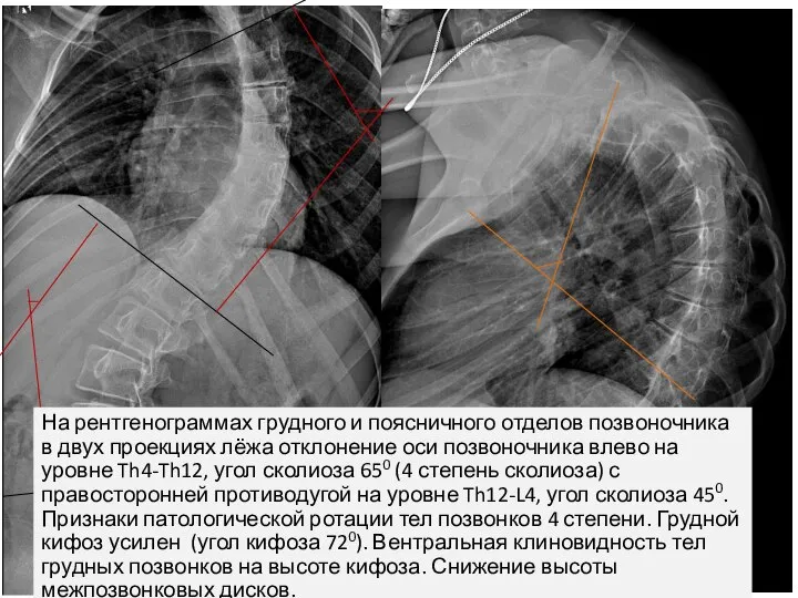 На рентгенограммах грудного и поясничного отделов позвоночника в двух проекциях лёжа отклонение