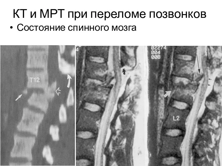 КТ и МРТ при переломе позвонков Состояние спинного мозга