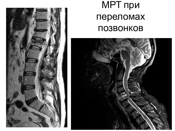 МРТ при переломах позвонков