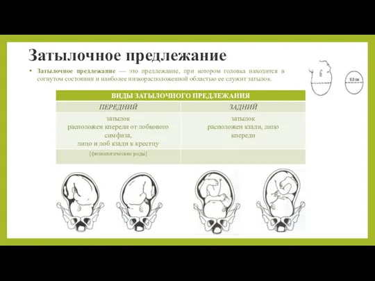 Затылочное предлежание Затылочное предлежание — это предлежание, при котором головка находится в