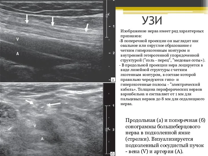 УЗИ Продольная (а) и поперечная (б) сонограммы большеберцового нерва в подколенной ямке