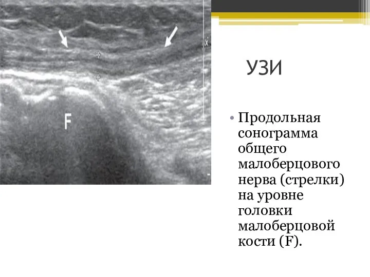 УЗИ Продольная сонограмма общего малоберцового нерва (стрелки) на уровне головки малоберцовой кости (F).