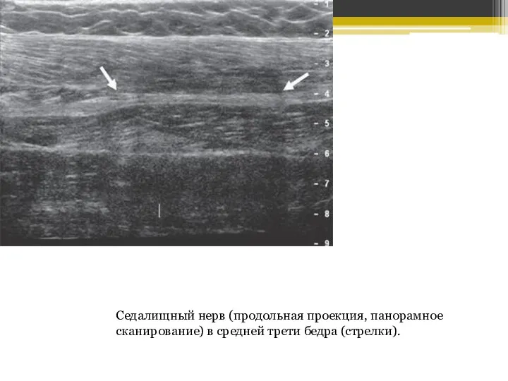 Седалищный нерв (продольная проекция, панорамное сканирование) в средней трети бедра (стрелки).