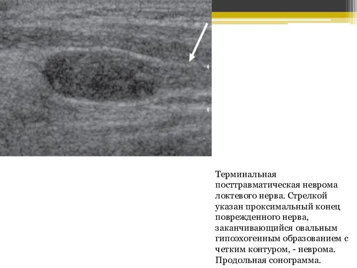 Терминальная посттравматическая неврома локтевого нерва. Стрелкой указан проксимальный конец поврежденного нерва, заканчивающийся
