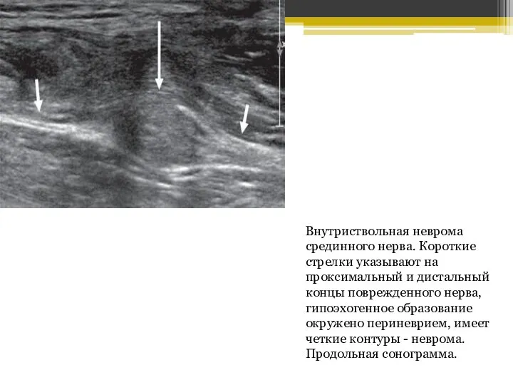 Внутриствольная неврома срединного нерва. Короткие стрелки указывают на проксимальный и дистальный концы