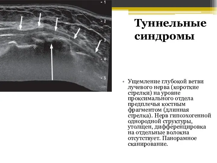 Ущемление глубокой ветви лучевого нерва (короткие стрелки) на уровне проксимального отдела предплечья