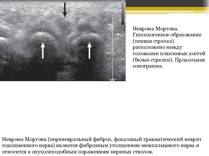 Неврома Мортона. Гипоэхогенное образование (темная стрелка) расположено между головками плюсневых костей (белые