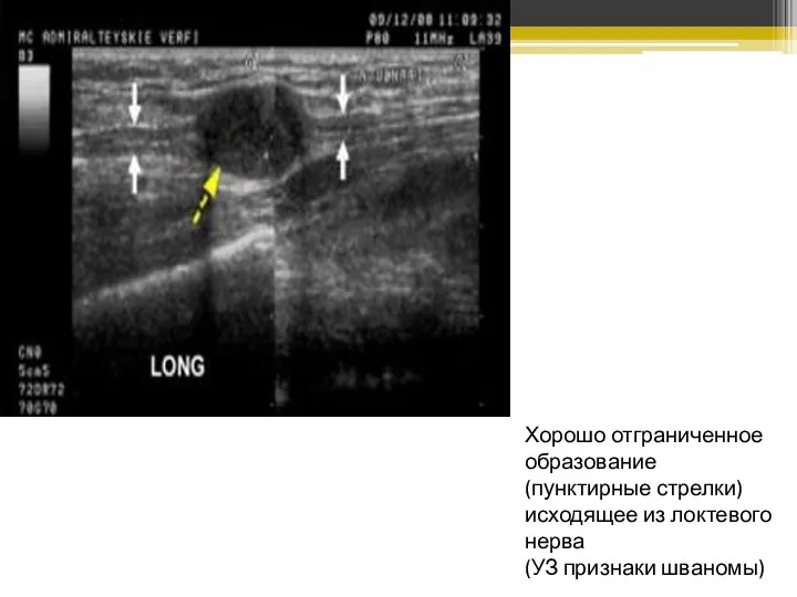 Хорошо отграниченное образование (пунктирные стрелки) исходящее из локтевого нерва (УЗ признаки шваномы)