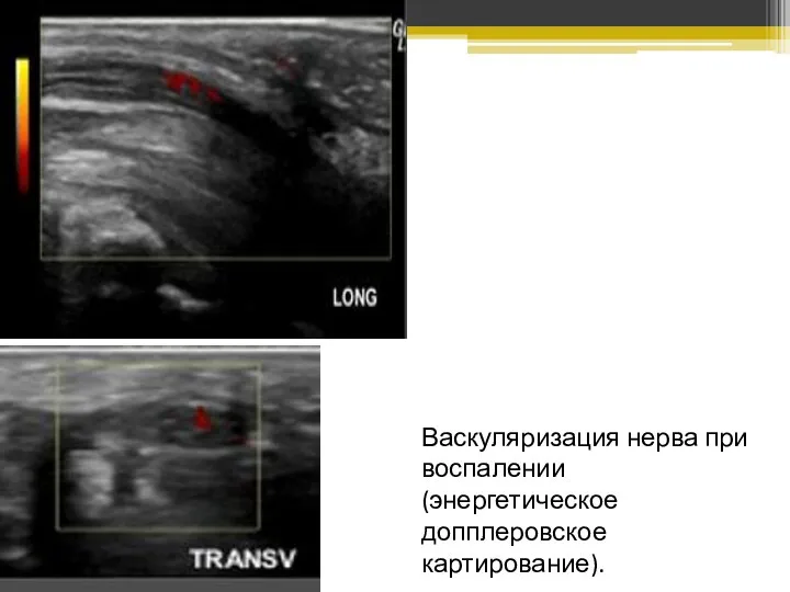 Васкуляризация нерва при воспалении (энергетическое допплеровское картирование).