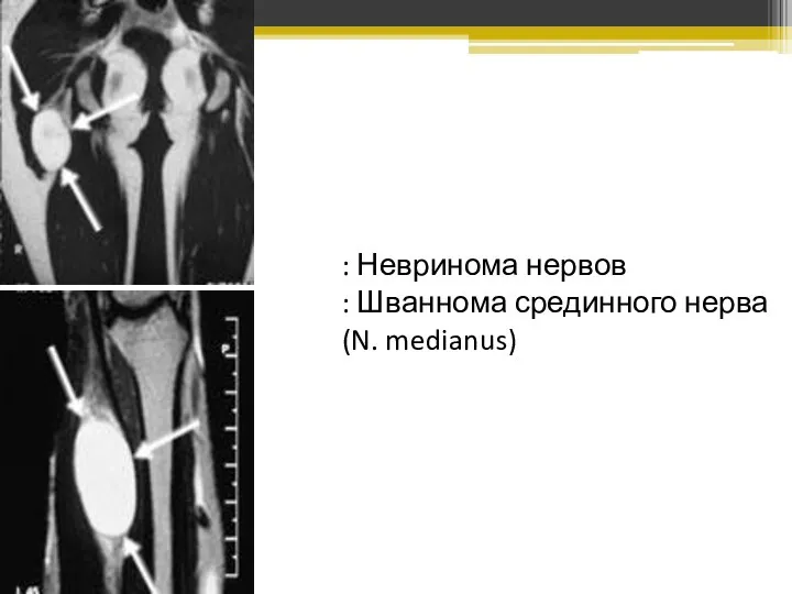 : Невринома нервов : Шваннома срединного нерва (N. medianus)