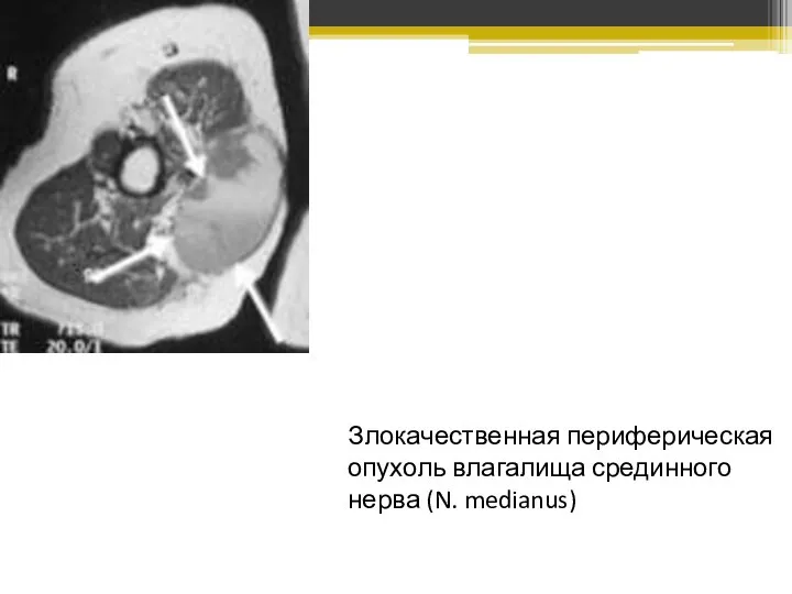 Злокачественная периферическая опухоль влагалища срединного нерва (N. medianus)