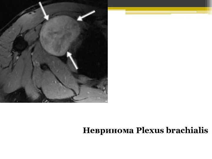 Невринома Plexus brachialis