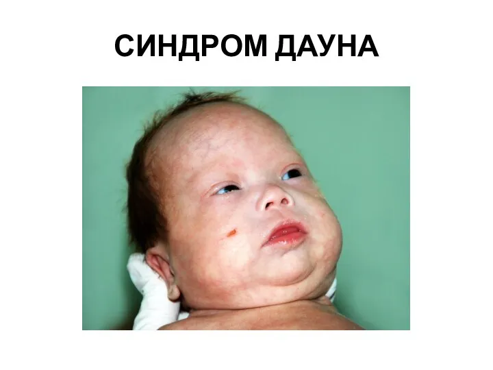 СИНДРОМ ДАУНА