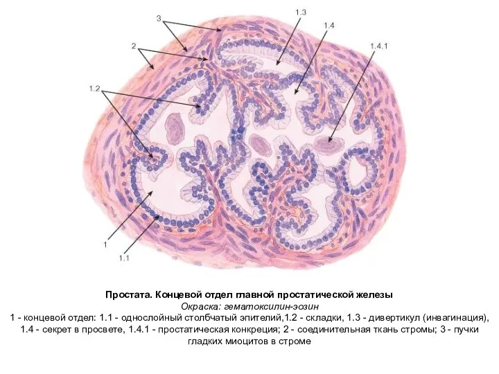 Простата. Концевой отдел главной простатической железы Окраска: гематоксилин-эозин 1 - концевой отдел: