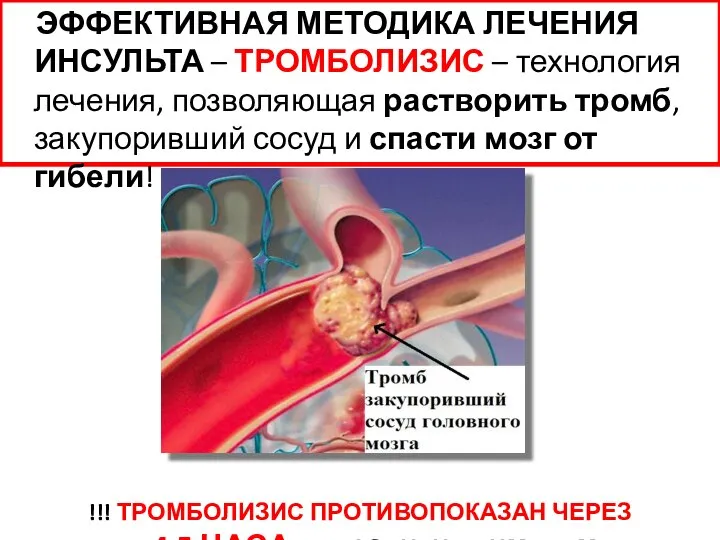 ЭФФЕКТИВНАЯ МЕТОДИКА ЛЕЧЕНИЯ ИНСУЛЬТА – ТРОМБОЛИЗИС – технология лечения, позволяющая растворить тромб,