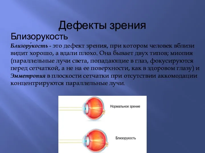 Дефекты зрения Близорукость Близору́кость - это дефект зрения, при котором человек вблизи