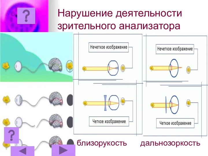 Нарушение деятельности зрительного анализатора близорукость дальнозоркость