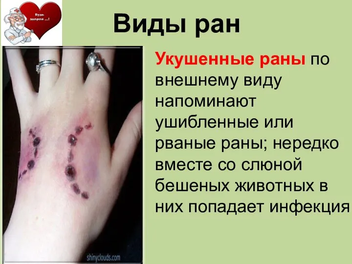 Укушенные раны по внешнему виду напоминают ушибленные или рваные раны; нередко вместе
