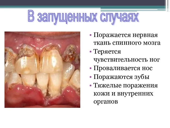 Поражается нервная ткань спинного мозга Теряется чувствительность ног Проваливается нос Поражаются зубы