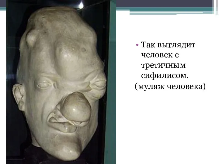 Так выглядит человек с третичным сифилисом. (муляж человека)