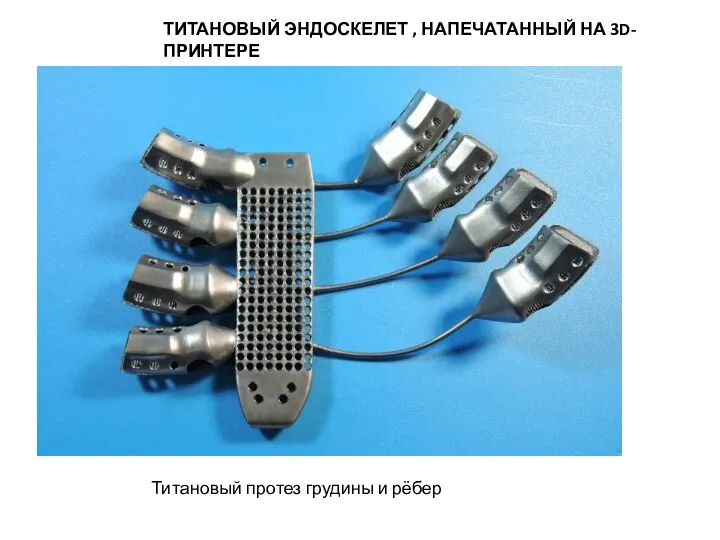 ТИТАНОВЫЙ ЭНДОСКЕЛЕТ , НАПЕЧАТАННЫЙ НА 3D-ПРИНТЕРЕ Титановый протез грудины и рёбер