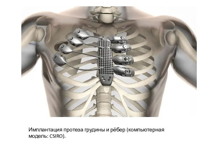 Имплантация протеза грудины и рёбер (компьютерная модель: CSIRO).