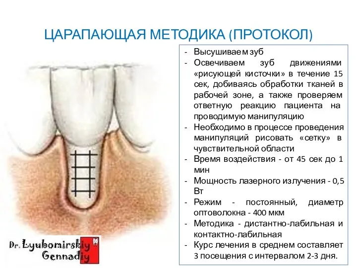 ЦАРАПАЮЩАЯ МЕТОДИКА (ПРОТОКОЛ) ФОТО Высушиваем зуб Освечиваем зуб движениями «рисующей кисточки» в