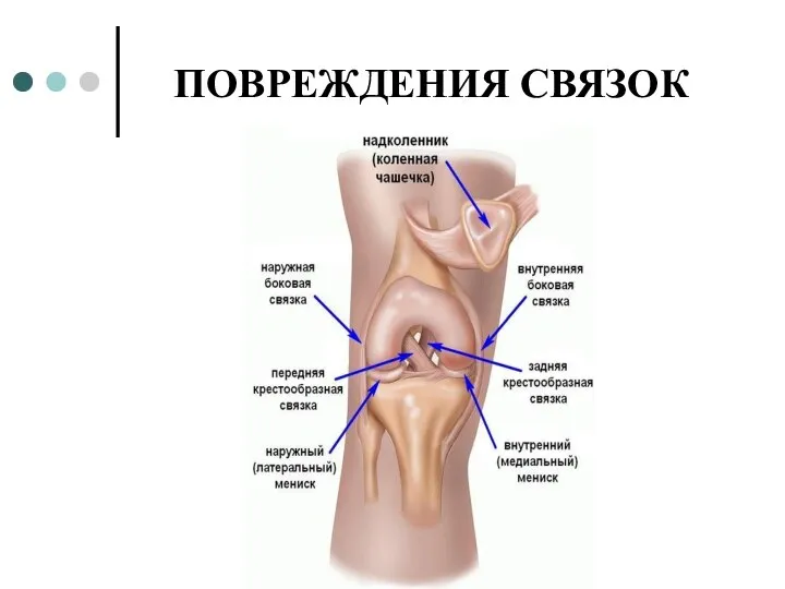 ПОВРЕЖДЕНИЯ СВЯЗОК