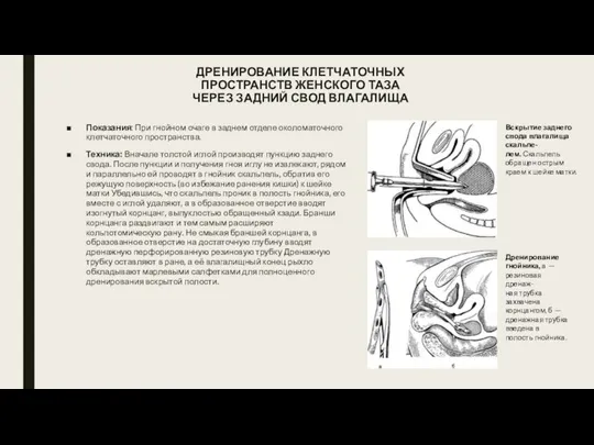 ДРЕНИРОВАНИЕ КЛЕТЧАТОЧНЫХ ПРОСТРАНСТВ ЖЕНСКОГО ТАЗА ЧЕРЕЗ ЗАДНИЙ СВОД ВЛАГАЛИЩА Показания: При гнойном