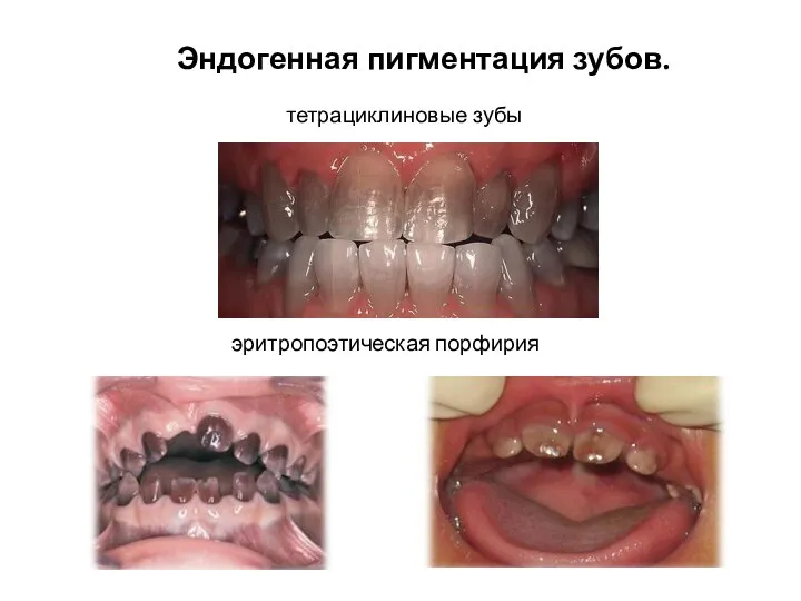 тетрациклиновые зубы эритропоэтическая порфирия Эндогенная пигментация зубов.