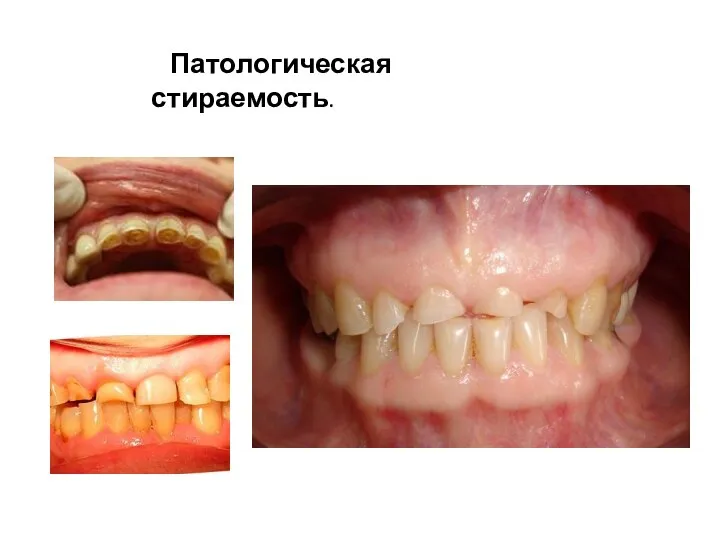 Патологическая стираемость.