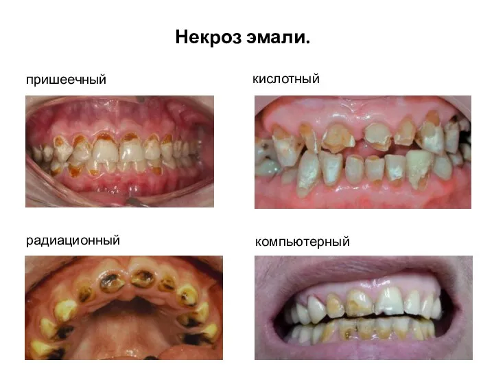 радиационный пришеечный компьютерный кислотный Некроз эмали.