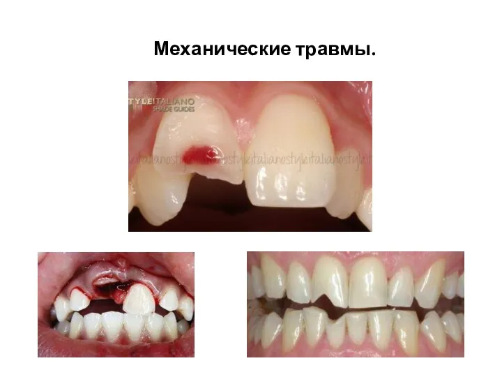 Механические травмы.