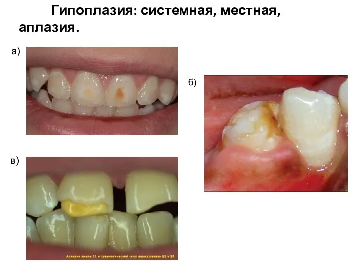 б) а) в) Гипоплазия: системная, местная, аплазия.