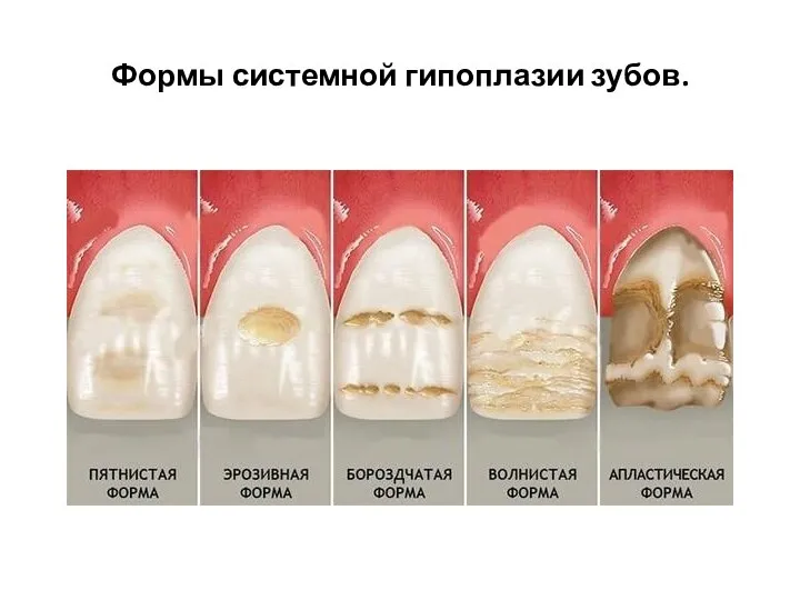 Формы системной гипоплазии зубов.