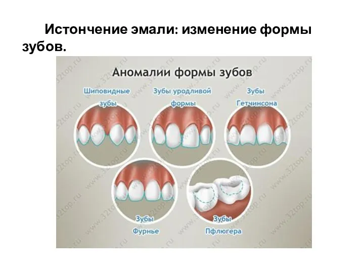 Истончение эмали: изменение формы зубов.