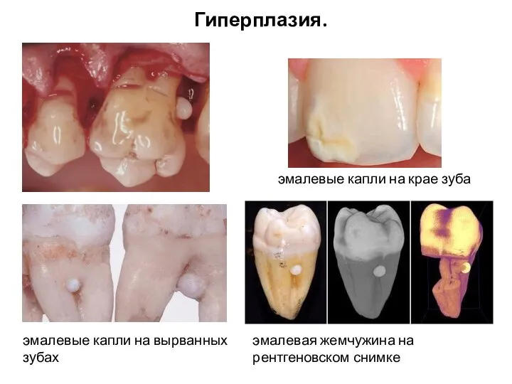 эмалевые капли на вырванных зубах эмалевая жемчужина на рентгеновском снимке эмалевые капли на крае зуба Гиперплазия.