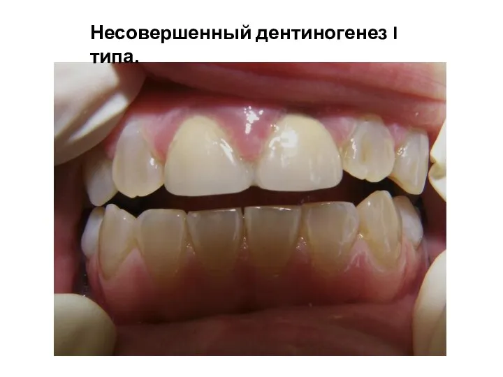 Несовершенный дентиногенез I типа.