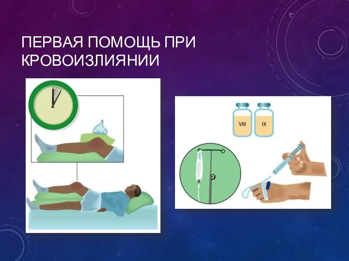 ПЕРВАЯ ПОМОЩЬ ПРИ КРОВОИЗЛИЯНИИ