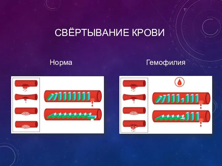 СВЁРТЫВАНИЕ КРОВИ Норма Гемофилия