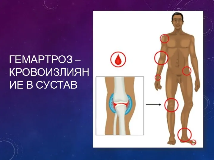 ГЕМАРТРОЗ – КРОВОИЗЛИЯНИЕ В СУСТАВ