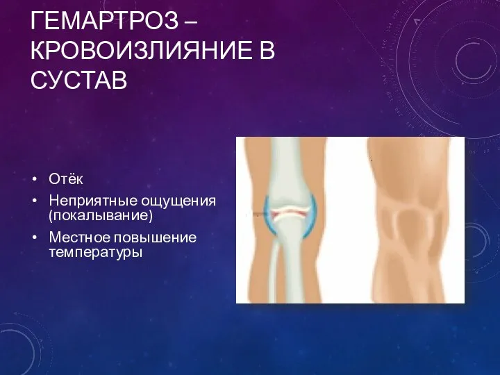 ГЕМАРТРОЗ – КРОВОИЗЛИЯНИЕ В СУСТАВ Отёк Неприятные ощущения (покалывание) Местное повышение температуры