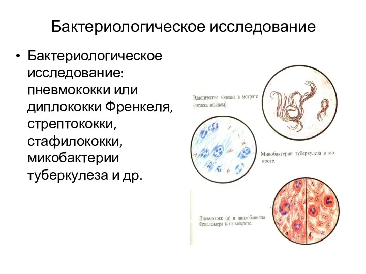 Бактериологическое исследование Бактериологическое исследование: пневмококки или диплококки Френкеля, стрептококки, стафилококки, микобактерии туберкулеза и др.