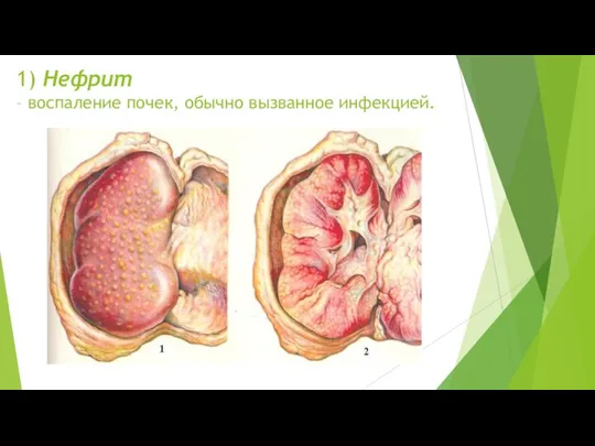 1) Нефрит – воспаление почек, обычно вызванное инфекцией.