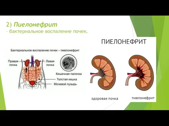 2) Пиелонефрит – бактериальное воспаление почек.