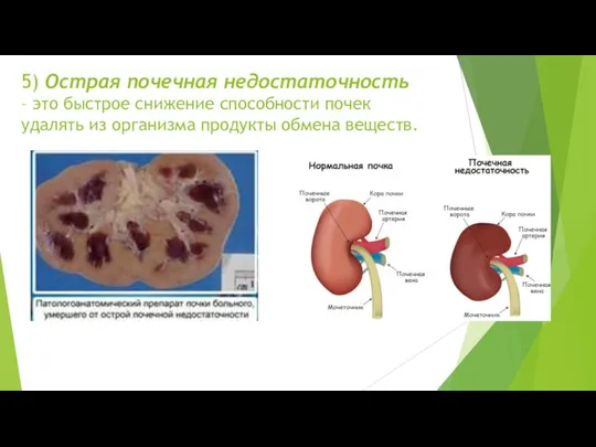 5) Острая почечная недостаточность – это быстрое снижение способности почек удалять из организма продукты обмена веществ.