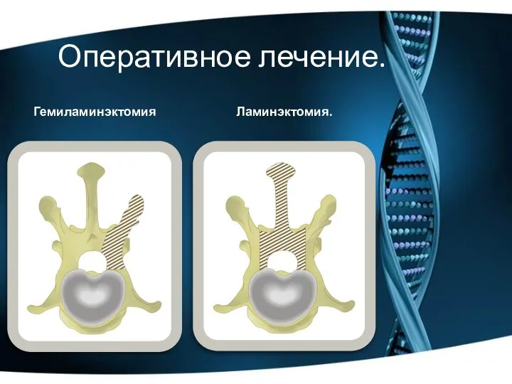 Ламинэктомия. Гемиламинэктомия Оперативное лечение.