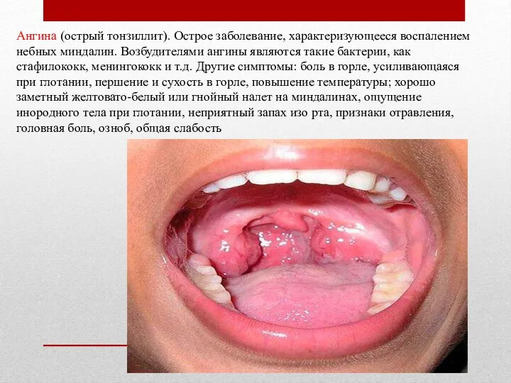 Ангина (острый тонзиллит). Острое заболевание, характеризующееся воспалением небных миндалин. Возбудителями ангины являются